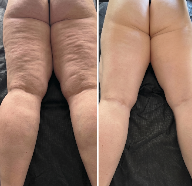 Cellulitis