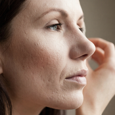 Acne & Wrinkles